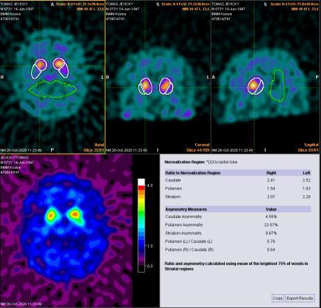 Scintigrafia receptorov mozgu DaT scan 3. PRESYNAPTICKÉ vyšetrenie - Kvantifikácia Nucleus caudatus + putamen = striatum J.