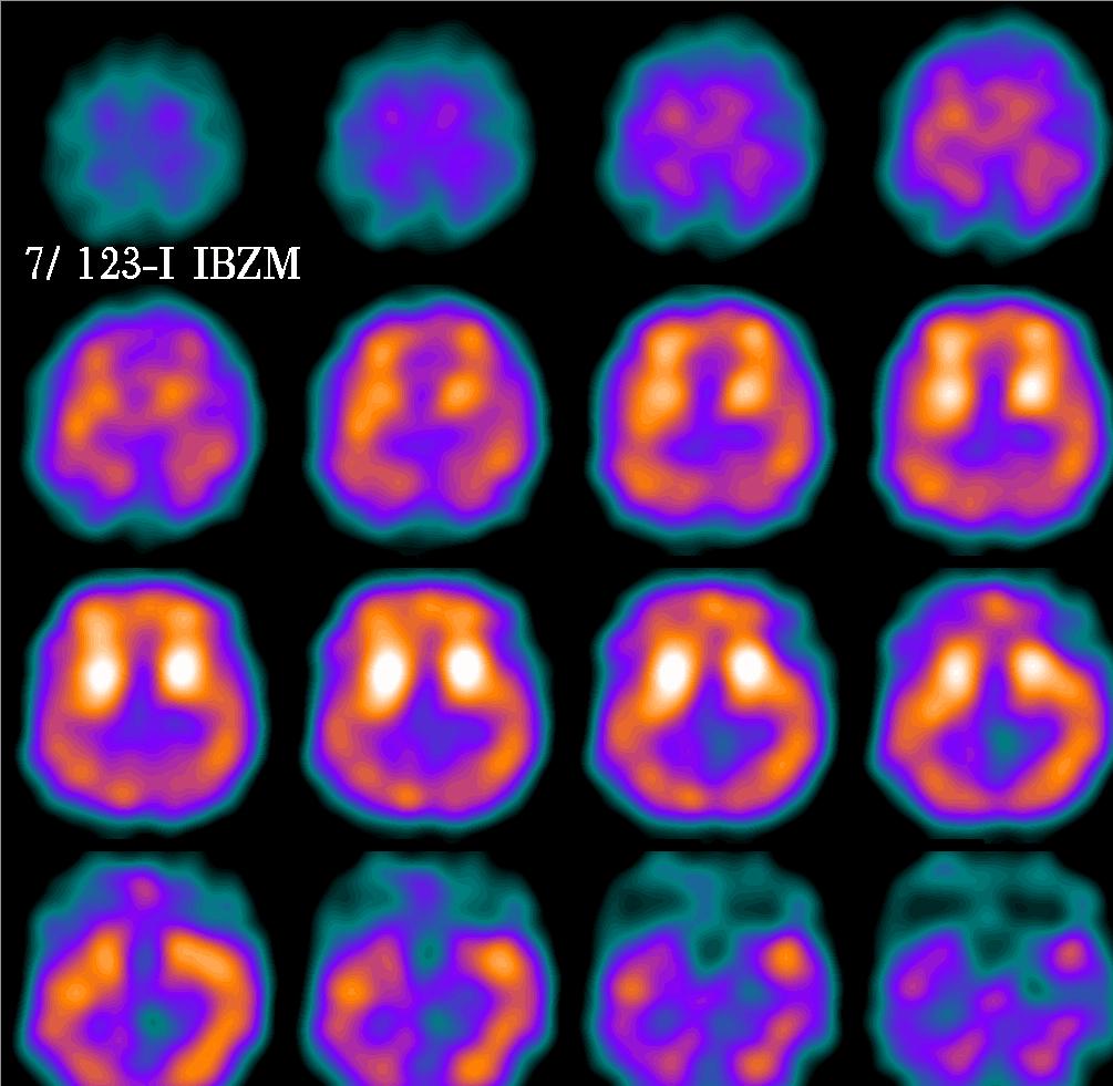 Scintigrafia receptorov mozgu IMZB 4.