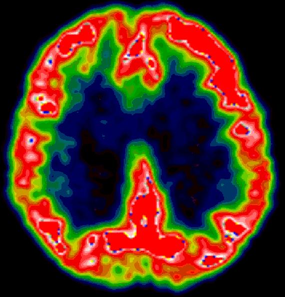 PET MOZGU (pozitrónová emisná tomografia) Aké zobrazenie pomocou NM používame na diagnostiku demencie: 1.