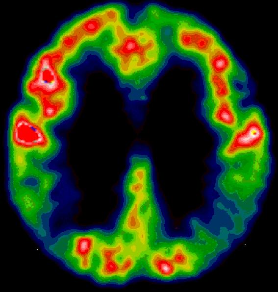 Vyhodnotenie pacientov s podozrením na demenciu; 3. Detekcia a hodnotenie cerebrovaskulárnych chorôb: 4.