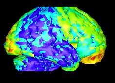 Alzheimerova choroba Patologický proces vedie k hromadeniu τ-proteínu a amyloidu zobrazí 11