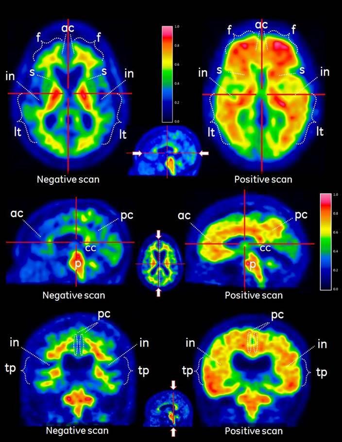 18 F-Visamil PET/CT(MRI) v diagnostike demencie
