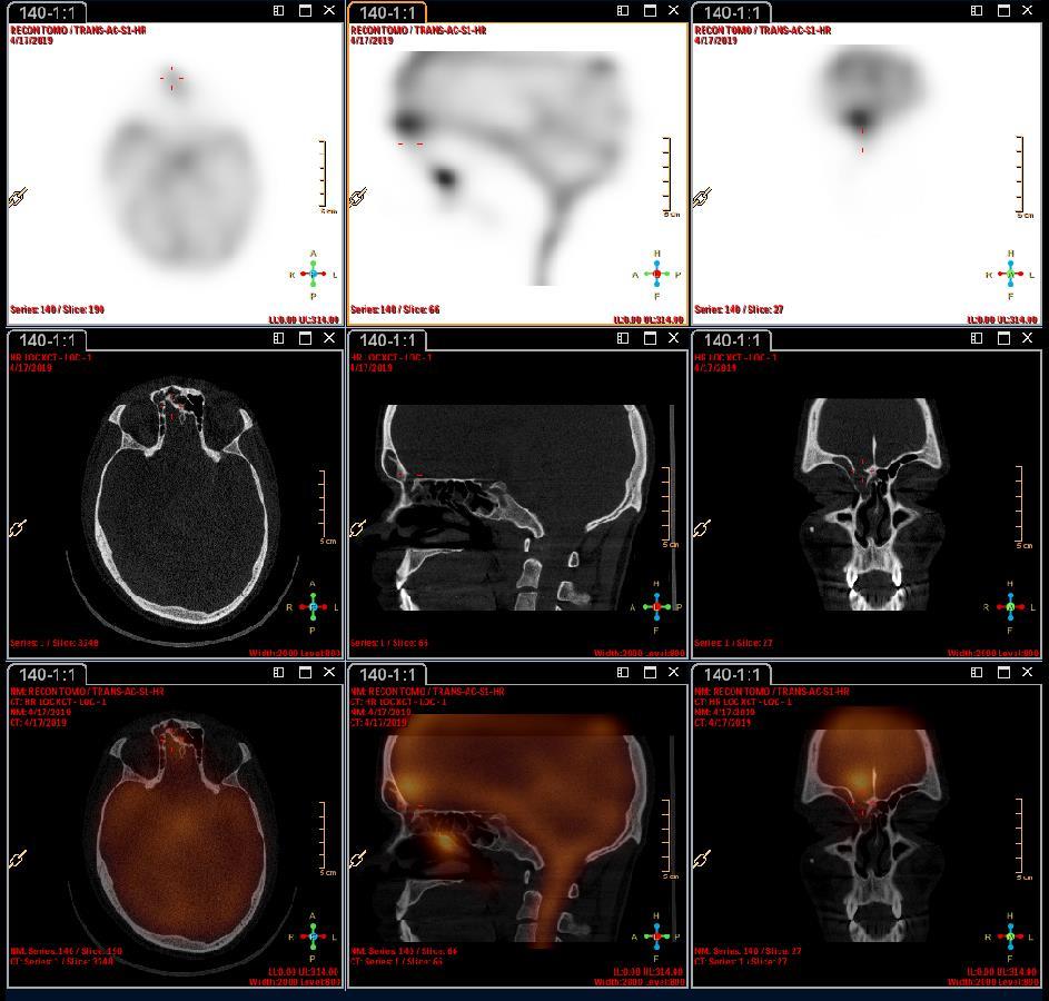Radionuklidová cisternografia SPECT/CT 2. vyšetrenie je pozitívne 23 r. muž, po autonehode v 2011, trauma hlavy.