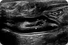 Ultrasonografický vzhľad steny čreva perforovanej cudzím telesom, akými sú napríklad paličky, predstavuje lokálne zhrubnutie a ložiskovú stratu jednotlivých vrstiev.