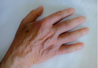 Balneoterapia psoriatickej artritídy 7 Najčastejšie sa iniciálne diagnostikuje asymetrická oligoartikulárna forma (50 %), ktorá postihuje distálne a proximálne interfalangeálne kĺby rúk a nôh,
