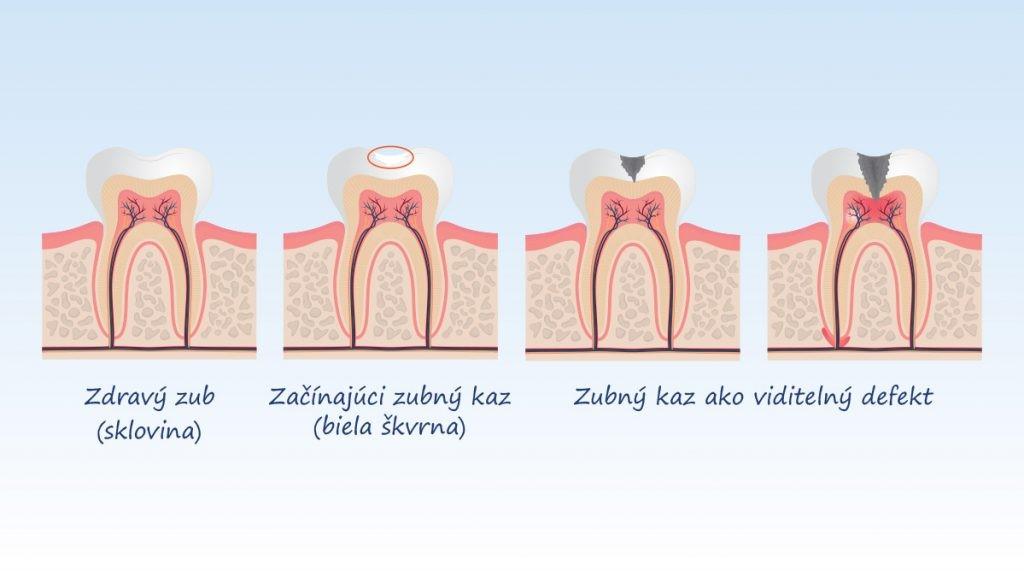 10. NÁHRADNÉ SLADIDLÁ A ZUBNÝ KAZ Na zdravie ústnej dutiny vrátane zubov má veľký vplyv potrava a jej zloženie.