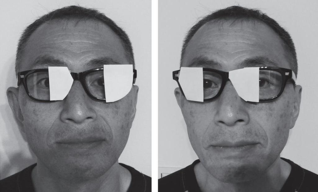 Obrázok 5 Špeciálne okuliare na prekrytie zorného poľa prekrytie ľavého (vľavo) a pravého zorného poľa (vpravo) oboch očí (Sugimoto a Fujino, 2017, s. 3) 6.5.2 Vestibulárna stimulácia Hlavným deficitom pacientov s unilaterálnym neglectom je orientačná zaujatosť smerom doprava.