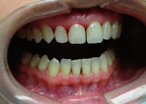 45-49 Siebert 5: MUSTR PARODONTOLOGIE 4/7/08 10:33 AM Stránka 46 na zubných krčkov nepozorovala zmeny tvaru a priebehu gingívy, neudávala pocit kývania zubov.