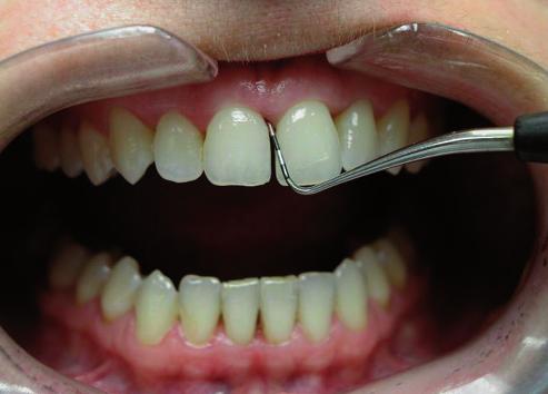 Zuby si umývala dvakrát denne zubnou kefkou a pastou, bez použitia doplnkových prostriedkov dentálnej hygieny (zubná niť, interdentálne kefky apod.).