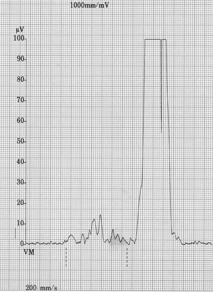 Trvanie vlny P 109 ms a redukcia výsledného šumu 0,27 µv (MAC 5000, GE Medical, USA) [A Record of P wave SA-ECG in patient without documented paroxysmal atrial fibrillation.