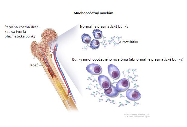 DEFINÍCIA MNOHOPOČETNÉHO MYELÓMU MM je nádorové ochorenie plazmatických buniek*. Ide o typ bielych krviniek, ktoré pochádzajú z kostnej drene. Funkciou plazmatických buniek* je produkovať protilátky*.