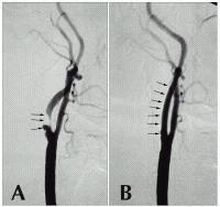 STENT Arteria carotis interna