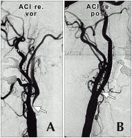STENT Arteria carotis interna