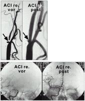Arteria carotis - Stenóza - Stent