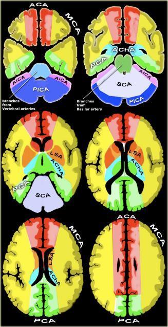 ACA arteria cerebri anterior, MCA arteria cerebri media, PCA arteria cerebri posterior, AChA arteria chorioidea anterior, SCA arteria