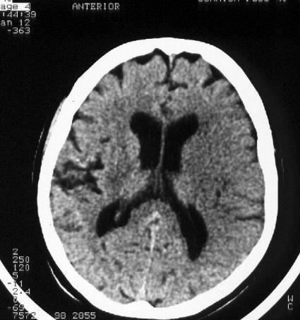 CT mozgu