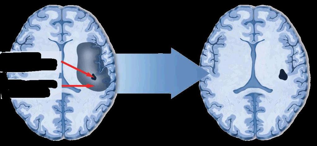 Možnosť úpravy neurologického poškodenia trombolytickou reperfúziou Ischemické jadro (mozgové tkanivo