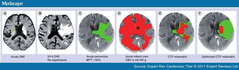 Perfúzne CT mozgu - mismatch (A & B) DWI akútne a o 24 hodín nie je reperfúzia (C & D) - penumbra (MTT >145%)