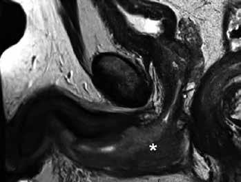 Mnohopočetný urotelový karcinóm močovej rúry v Ta štádiu u 79-ročného muža (A); stav jeden mesiac po transuretrálnej resekcii a koagulácii nádorov (B) (foto autora) A B Rádiologické zobrazovanie UC