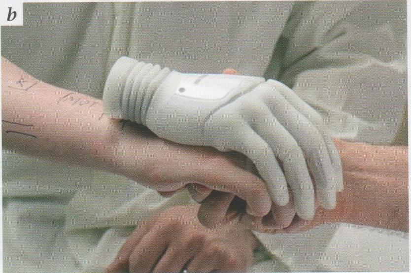 Obrázok 7 Prirovnanie protézovej dlane k plánovej amputácií predlaktia.