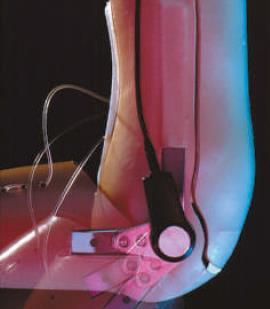 156) Tento tvar kýpťa spôsobuje relatívne komplikácie pri výrobe lôžka a núti ortopedického technika voliť vždy individuálne riešenia, no prináša aj jednu veľkú