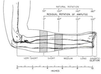 Obrázok 25 Vplyv dĺžky kýpťa na zachovanie rozsahu pronácie a supinácie Zdroj (20) Podobne ako pri exartikulácií v lakťovom kĺbe, tak aj v prípade transcarpálnej amputácie je distálna časť