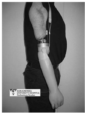 Obrázok 29 Ukážka použitia osseointegrácie pri aplikácii protézy hornej končatiny 1 Bohužiaľ aj s osseointegráciu sa spájajú rôzne riziká.